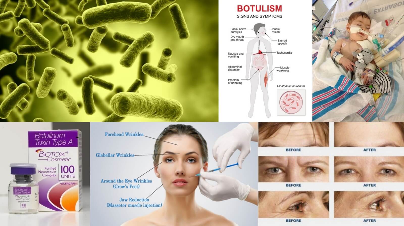 botulinum deadly poison